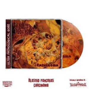 CD - BLASTED PANCREAS - Carcinoma